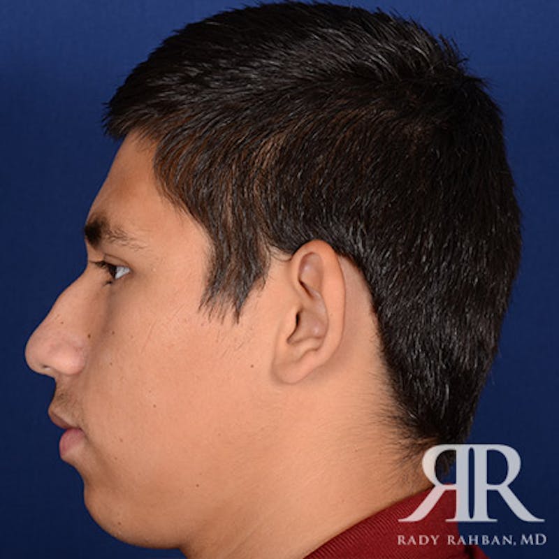 Ear Pinning Surgery Before & After Gallery - Patient 101619 - Image 3