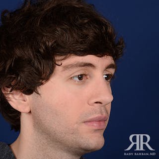 Chin Augmentation Before & After Gallery - Patient 354287 - Image 4