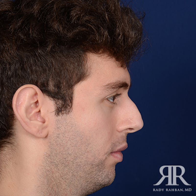 Chin Augmentation Before & After Gallery - Patient 354287 - Image 5