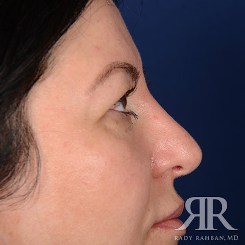 Eyelid Surgery Before & After Gallery - Patient 366009 - Image 5