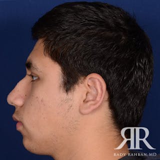 Ear Pinning Surgery Before & After Gallery - Patient 101619 - Image 4