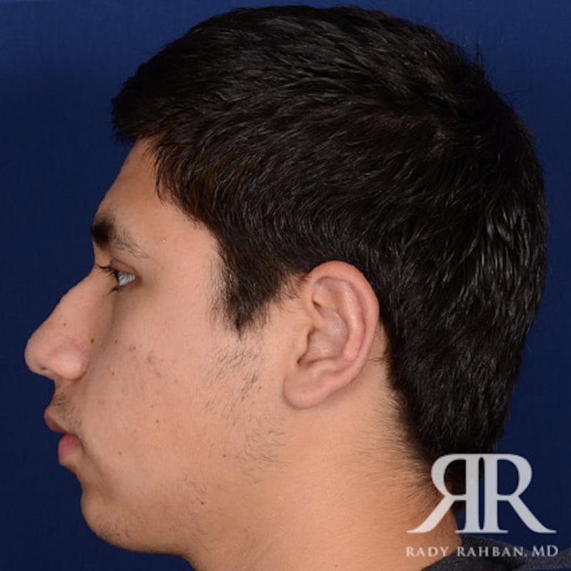 Ear Pinning Surgery Before & After Gallery - Patient 101619 - Image 4