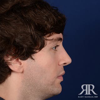 Chin Augmentation Before & After Gallery - Patient 354287 - Image 6
