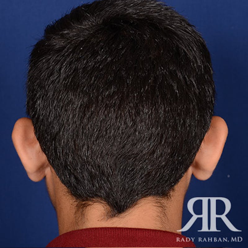 Ear Pinning Surgery Before & After Gallery - Patient 101619 - Image 5