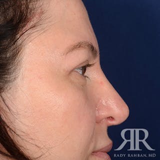 Eyelid Surgery Before & After Gallery - Patient 366009 - Image 6