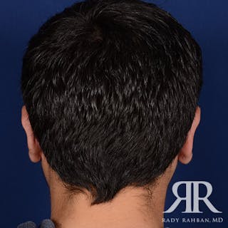 Ear Pinning Surgery Before & After Gallery - Patient 101619 - Image 6