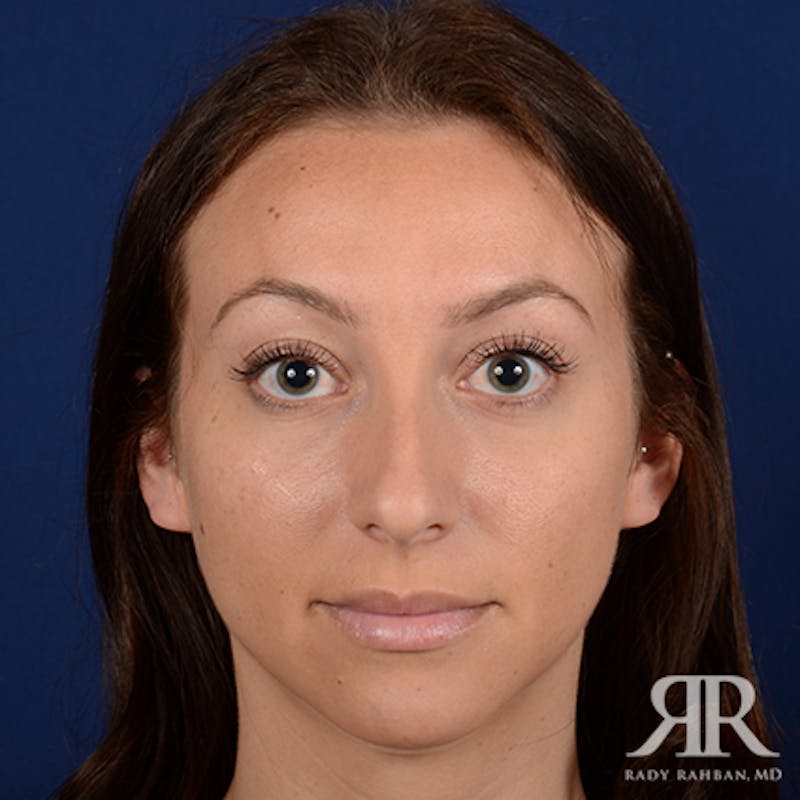 Chin Augmentation Before & After Gallery - Patient 406490 - Image 1