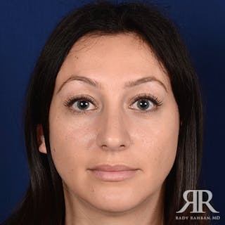 Chin Augmentation Before & After Gallery - Patient 406490 - Image 2