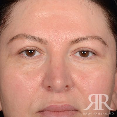 Browlift Before & After Gallery - Patient 951796 - Image 2