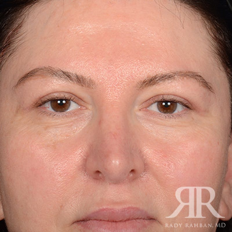 Browlift Before & After Gallery - Patient 951796 - Image 2