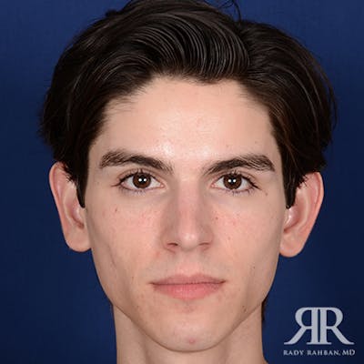 Ear Pinning Surgery Before & After Gallery - Patient 393480 - Image 1