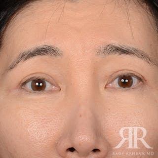 Eyelid Surgery Before & After Gallery - Patient 427435 - Image 2