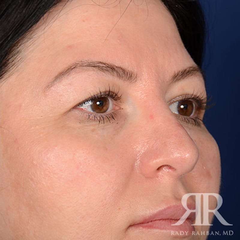Browlift Before & After Gallery - Patient 951796 - Image 3
