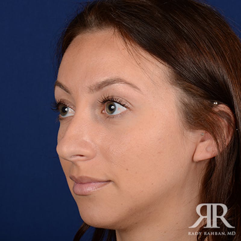 Chin Augmentation Before & After Gallery - Patient 406490 - Image 3
