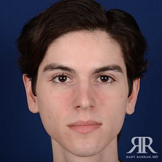 Ear Pinning Surgery Before & After Gallery - Patient 393480 - Image 2