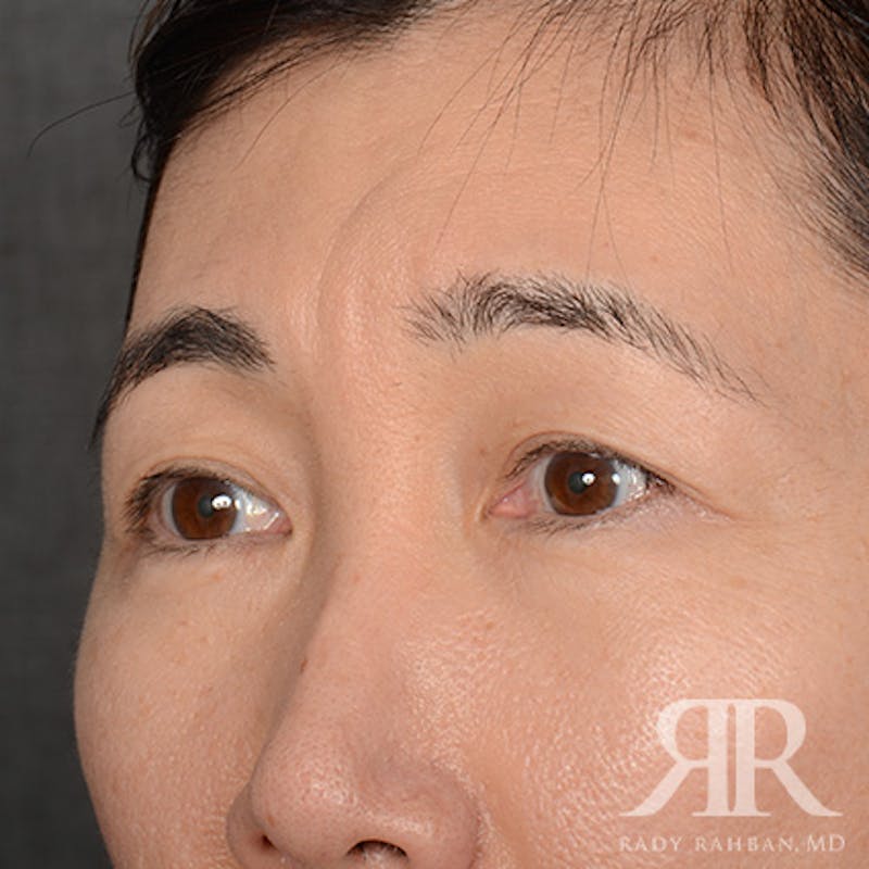 Eyelid Surgery Before & After Gallery - Patient 427435 - Image 3