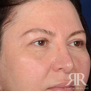 Browlift Before & After Gallery - Patient 951796 - Image 4