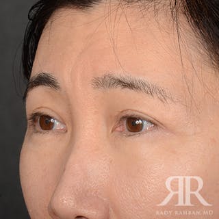 Eyelid Surgery Before & After Gallery - Patient 427435 - Image 4