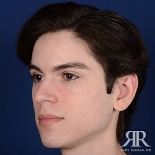 Ear Pinning Surgery Before & After Gallery - Patient 393480 - Image 4