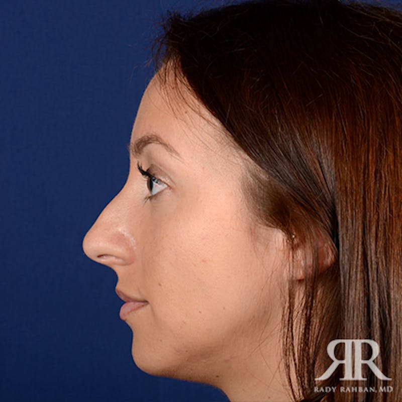 Chin Augmentation Before & After Gallery - Patient 406490 - Image 5