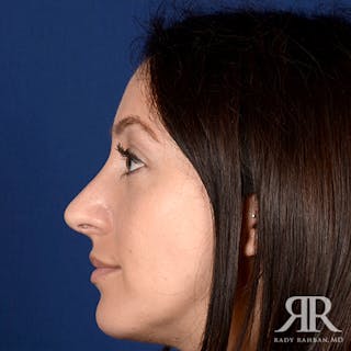Chin Augmentation Before & After Gallery - Patient 406490 - Image 6