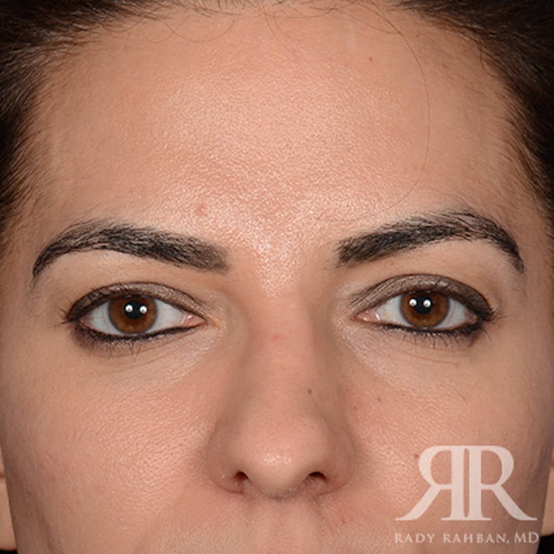 Browlift Before & After Gallery - Patient 827247 - Image 1