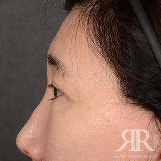 Eyelid Surgery Before & After Gallery - Patient 427435 - Image 6