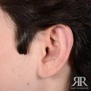 Ear Pinning Surgery Before & After Gallery - Patient 393480 - Image 6