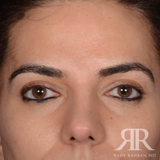 Browlift Before & After Gallery - Patient 827247 - Image 2