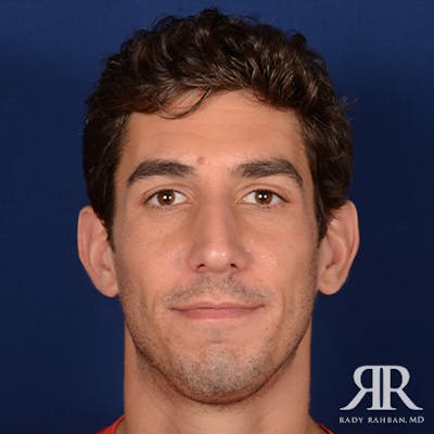 Chin Augmentation Before & After Gallery - Patient 950076 - Image 1