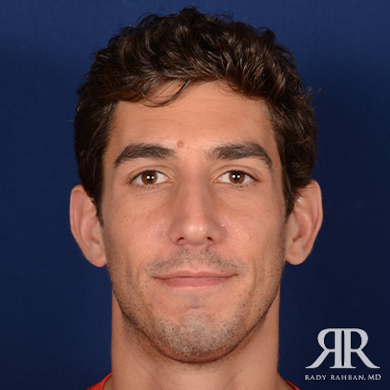 Chin Augmentation Before & After Gallery - Patient 950076 - Image 1