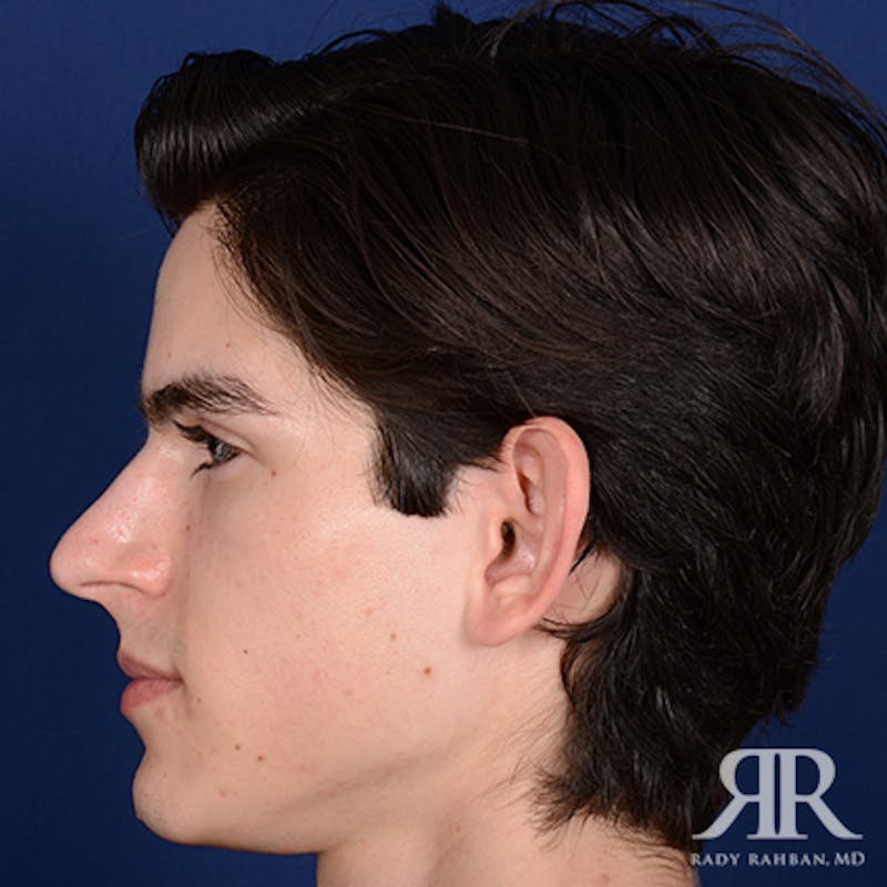 Ear Pinning Surgery Before & After Gallery - Patient 393480 - Image 7