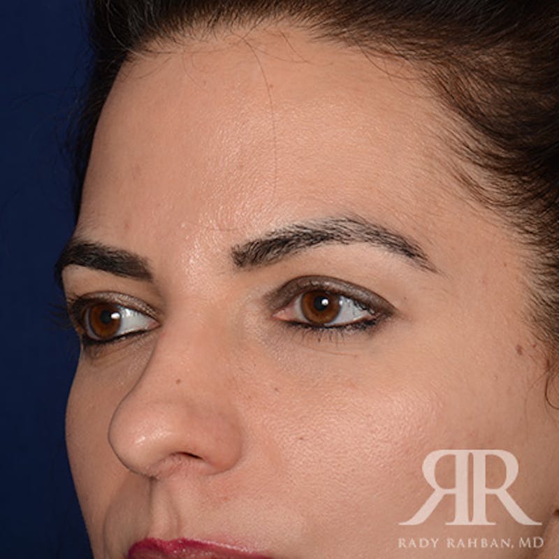 Browlift Before & After Gallery - Patient 827247 - Image 3