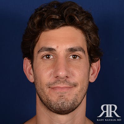 Chin Augmentation Before & After Gallery - Patient 950076 - Image 2