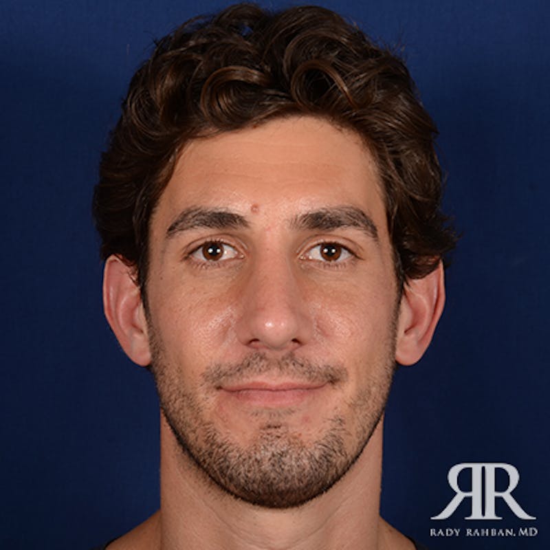Chin Augmentation Before & After Gallery - Patient 950076 - Image 2