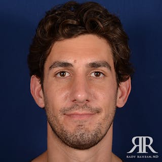 Chin Augmentation Before & After Gallery - Patient 950076 - Image 2