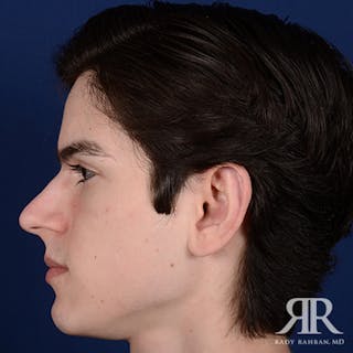 Ear Pinning Surgery Before & After Gallery - Patient 393480 - Image 8