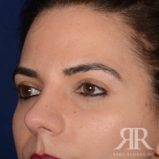 Browlift Before & After Gallery - Patient 827247 - Image 4