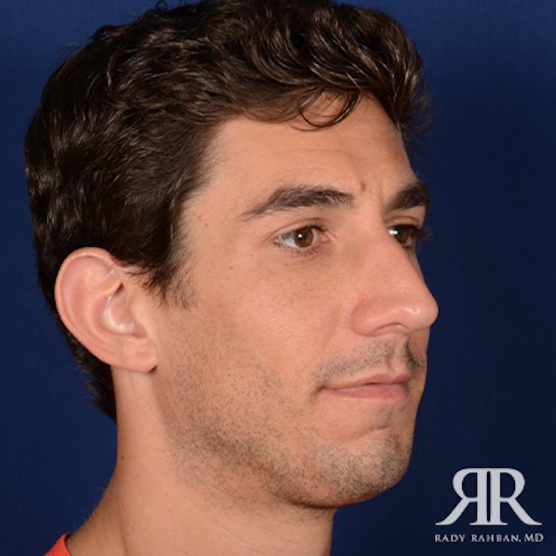 Chin Augmentation Before & After Gallery - Patient 950076 - Image 3