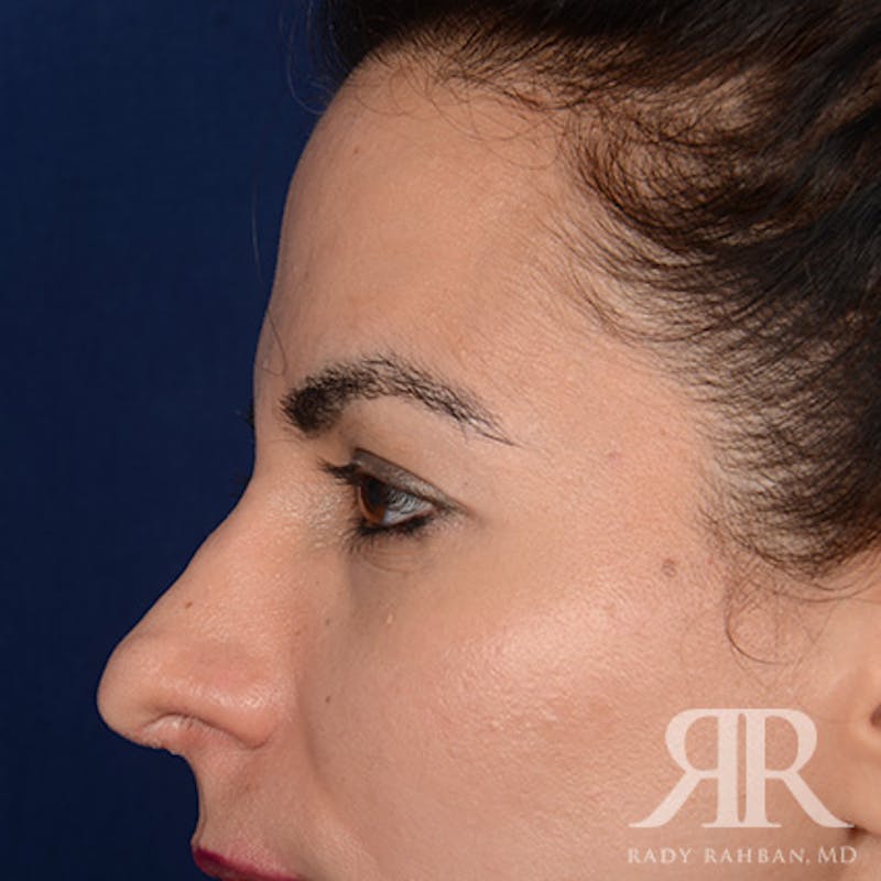 Browlift Before & After Gallery - Patient 827247 - Image 5