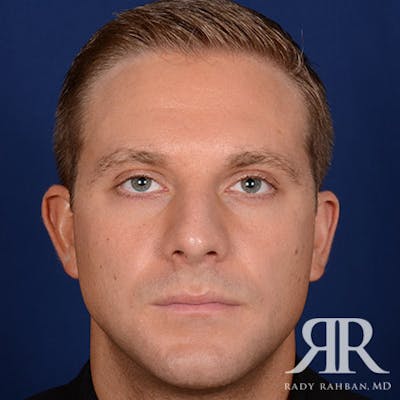 Ear Pinning Surgery Before & After Gallery - Patient 346354 - Image 1