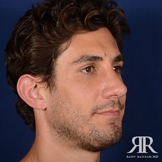 Chin Augmentation Before & After Gallery - Patient 950076 - Image 4