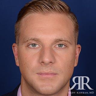 Ear Pinning Surgery Before & After Gallery - Patient 346354 - Image 2