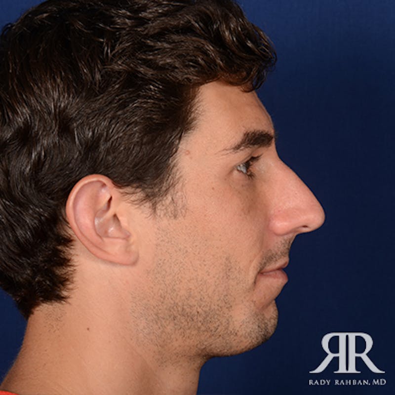 Chin Augmentation Before & After Gallery - Patient 950076 - Image 5