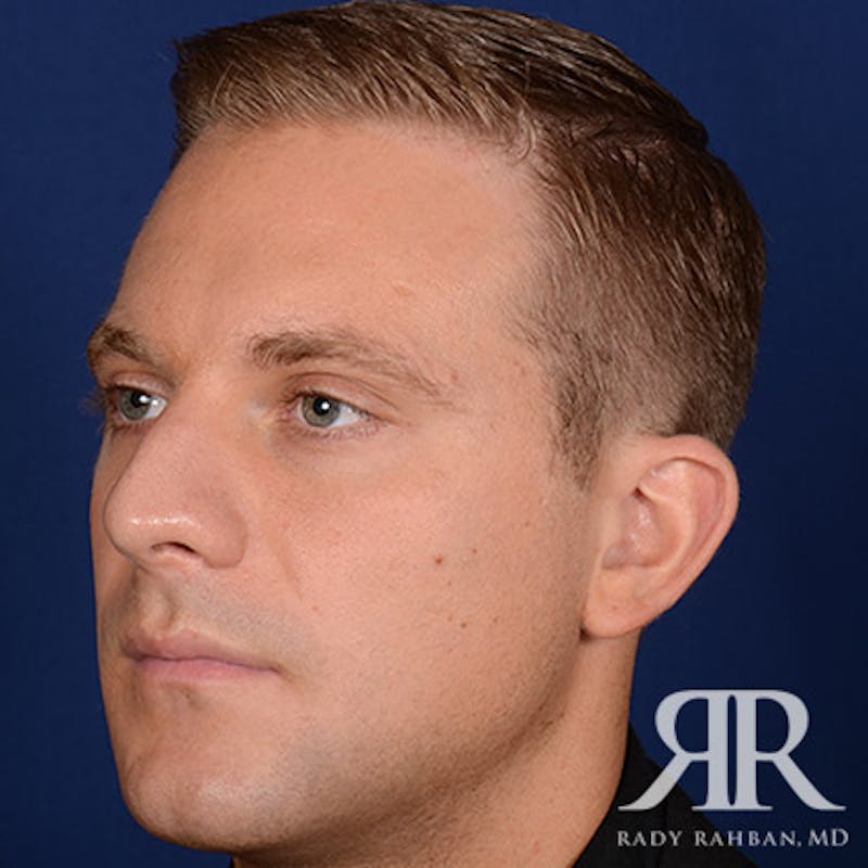 Ear Pinning Surgery Before & After Gallery - Patient 346354 - Image 3