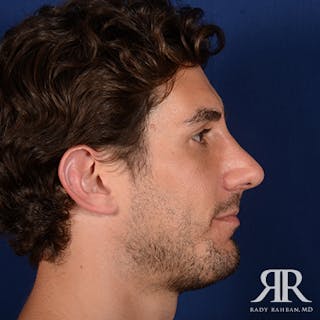 Chin Augmentation Before & After Gallery - Patient 950076 - Image 6
