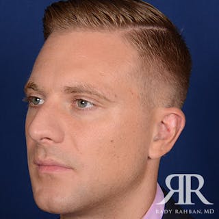 Ear Pinning Surgery Before & After Gallery - Patient 346354 - Image 4