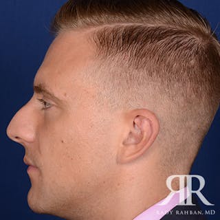 Ear Pinning Surgery Before & After Gallery - Patient 346354 - Image 6