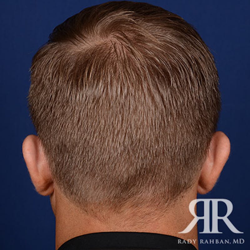 Ear Pinning Surgery Before & After Gallery - Patient 346354 - Image 7