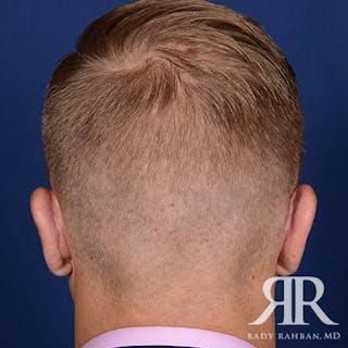 Ear Pinning Surgery Before & After Gallery - Patient 346354 - Image 8